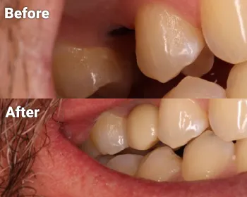 before and after photos of dental implants from North Phoenix cosmetic dentist Dr. Rick Campbell