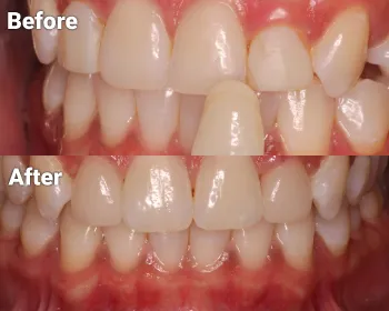 before and after photos showing tooth color matching