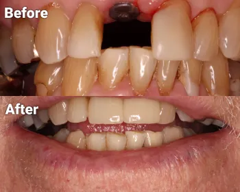 before and after photos of dental implants