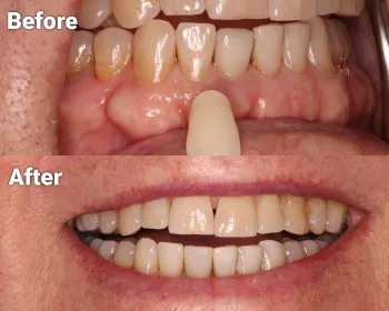 before and after photos of tooth color matching