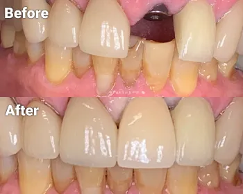 before and after photos of dental implant restoration by Dr. Rick Campbell