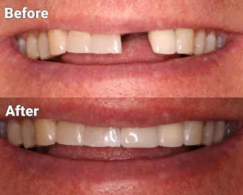 before and after photos of dental implant restoration in North Phoenix