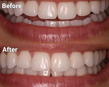 before and after photos of smile makeover