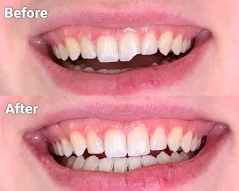 before and after photos of a chipped tooth repair