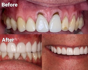 before and after photos for front teeth repair by North Phoenix cosmetic dentist Dr. Rick Campbell