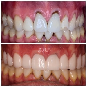 before and after crown and also before and after composite bonding